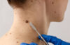 The Importance of Early Detection in Skin Cancer Treatment in Texas