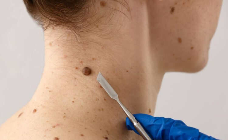 The Importance of Early Detection in Skin Cancer Treatment in Texas